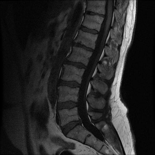 Pathologies du rachis : Troubles de la statique chez l’enfant et l’adolescent
